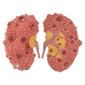 Polycystic Kidney Disease