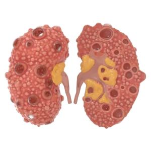 Polycystic Kidney Disease