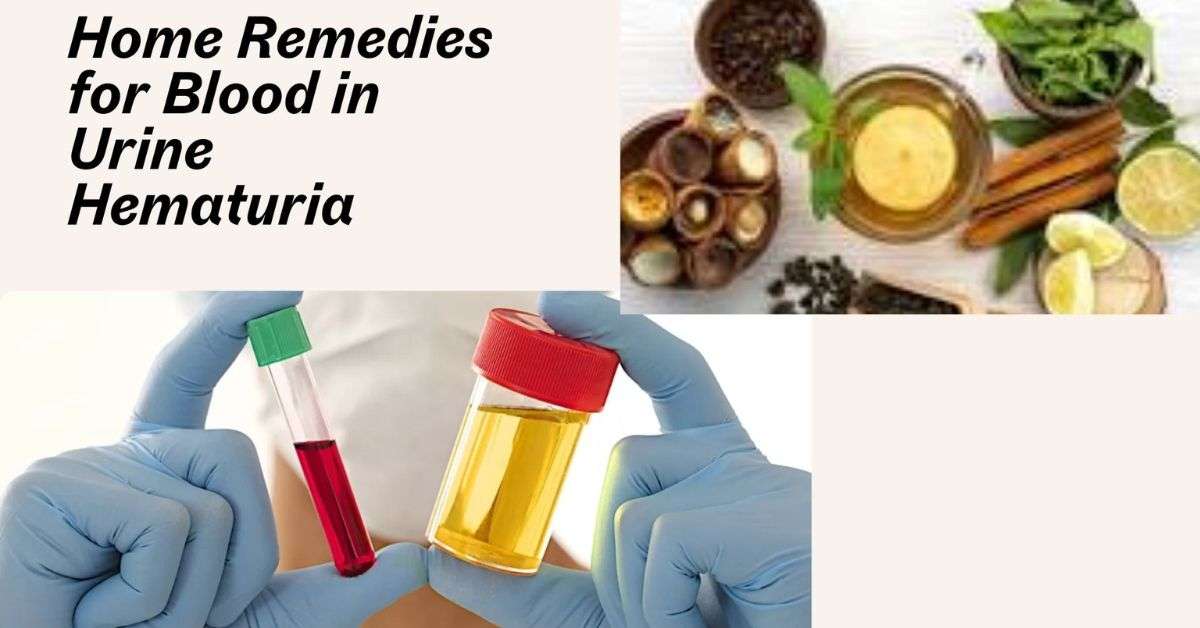 Home Remedies for Blood in Urine