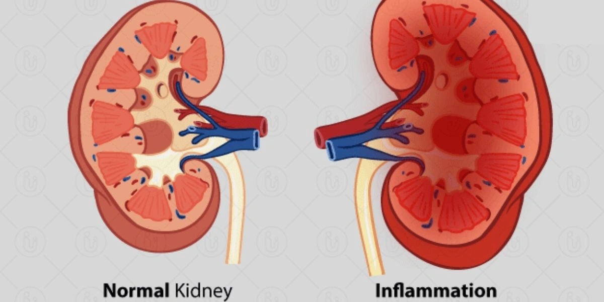 Kidney Inflammation